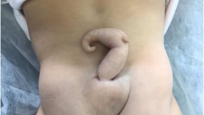 In medical terms, that structure is referred to as a “human pseudo-tail”, a growth that resembles a tail but is caused by spine problems or tumours. (Journal of Pediatric Surgery Case Reports)