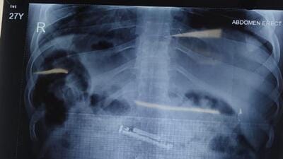 The doctors said the mobile phone was lying in the antrum of the stomach of the prisoner. (Sourced) The doctors said the mobile phone was lying in the antrum of the stomach of the prisoner. (Sourced)