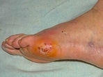Diabetes: Early detection and management of diabetic foot complications Diabetes: Early detection and management of diabetic foot complications