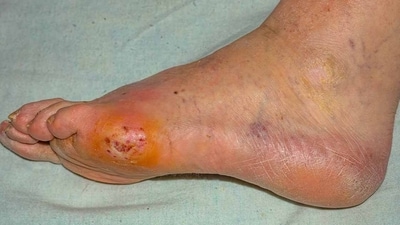 Diabetes: Early detection and management of diabetic foot complications (Photo by Twitter/HealthProRadio) Diabetes: Early detection and management of diabetic foot complications (Photo by Twitter/HealthProRadio)