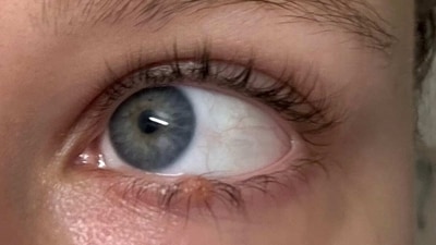 Eye care tips: What you should and shouldn't do when you have a stye in your eye (Photo by Twitter/brionnaa_xoxo) Eye care tips: What you should and shouldn't do when you have a stye in your eye (Photo by Twitter/brionnaa_xoxo)