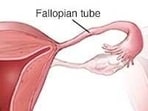 Fallopian Tube (Tubal) Reversal: Benefits, factors to consider before opting it 