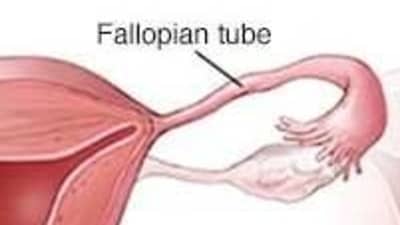 Fallopian Tube (Tubal) Reversal: Benefits, factors to consider before opting it (Photo by Twitter/SmallesTeaspoon) Fallopian Tube (Tubal) Reversal: Benefits, factors to consider before opting it (Photo by Twitter/SmallesTeaspoon)