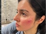 Divya Khosla Kumar sustained injury on face while working on a film. Divya Khosla Kumar sustained injury on face while working on a film.