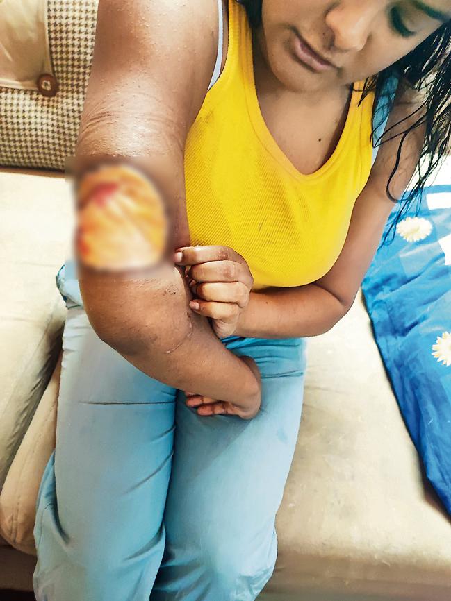 Dipti Mudaliar, a journalist with Hindustan Times, sustained serious injuries in a recent Pitbull attack Dipti Mudaliar, a journalist with Hindustan Times, sustained serious injuries in a recent Pitbull attack