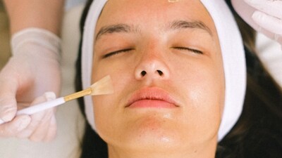 Chemical peels: A chemical peel is a cosmetic treatment that involves applying a chemical solution to the skin to remove the top layer of dead skin cells. This can help to reduce the appearance of acne scars and improve the overall texture of the skin.&nbsp; (Pexels)