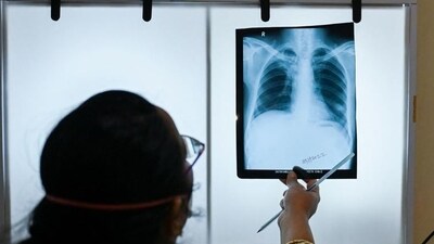 The world saw 1.6 million people succumbing to TB in 2021, making it the leading cause of death from an infectious disease before Covid-19 surpassed it. (AFP) (HT File) The world saw 1.6 million people succumbing to TB in 2021, making it the leading cause of death from an infectious disease before Covid-19 surpassed it. (AFP) (HT File)