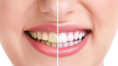 Teeth whitening is a popular cosmetic procedure that can help restore the natural white colour of teeth and enhance the appearance of your smile. (Getty Images/iStockphoto) Teeth whitening is a popular cosmetic procedure that can help restore the natural white colour of teeth and enhance the appearance of your smile. (Getty Images/iStockphoto)