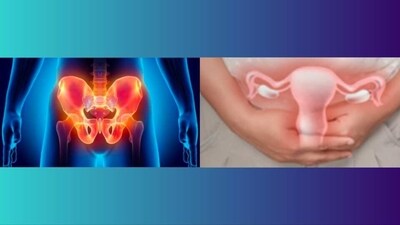 Genital tuberculosis and its impact on male and female infertility (Photo by Twitter/touchENDOCRINE/MyIndiainfo) Genital tuberculosis and its impact on male and female infertility (Photo by Twitter/touchENDOCRINE/MyIndiainfo)