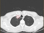 Paratracheal abscesses can block airways and lead to life-threatening infections, which can be deadly if not caught and treated quickly.