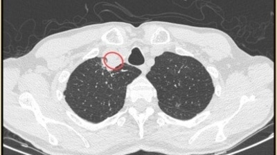 Paratracheal abscesses can block airways and lead to life-threatening infections, which can be deadly if not caught and treated quickly. Paratracheal abscesses can block airways and lead to life-threatening infections, which can be deadly if not caught and treated quickly.