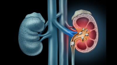 As many as 3,315 renal failure patients at PGIMER Chandigarh are awaiting kidney transplants. (Getty Images/iStockphoto) As many as 3,315 renal failure patients at PGIMER Chandigarh are awaiting kidney transplants. (Getty Images/iStockphoto)