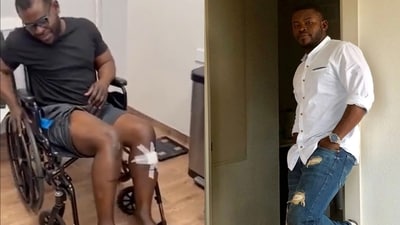 Moses Gibson increased his height from 5 feet 5 inches to 5 feet 8 inches after undergoing a procedure in 2016. (source:Twitter/@TheCosmeticLane) Moses Gibson increased his height from 5 feet 5 inches to 5 feet 8 inches after undergoing a procedure in 2016. (source:Twitter/@TheCosmeticLane)