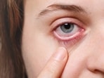 Extreme summer has arrived early in most parts of the country as dangerously high temperatures have been recorded in many states like West Bengal, Bihar and Andhra Pradesh. Extreme heat can take a toll on your eye health too with redness, itchiness and burning sensation becoming more common. Dr. Rishi Raj Borah, Country Director - India, Orbis shares tips to take care of your eyes in extreme heat.