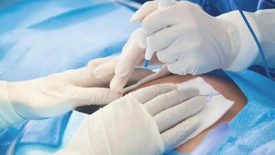 C-sections at private hospitals in the state has increased to 74.62% from 64.67% during 2020-22 (Representative Photo) C-sections at private hospitals in the state has increased to 74.62% from 64.67% during 2020-22 (Representative Photo)