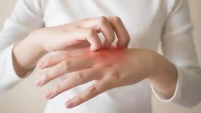 Greenery in early childhood does not protect against eczema: Study Greenery in early childhood does not protect against eczema: Study