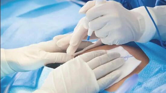 C-sections at private hospitals in the state has increased to 74.62% from 64.67% during 2020-22 (Representative Photo)