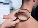 How new antibody can target and cure melanomas: Study