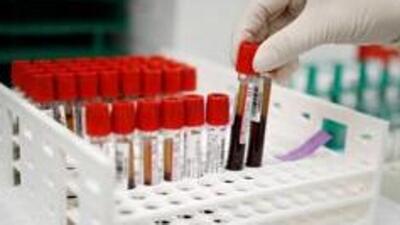 Liquid biopsy is a test that enables the diagnosis or analysis of tumours and cancer cells using only a blood or fluid sample rather than a solid tissue biopsy. (Reuters/ Representational image)