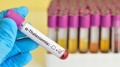 World Thalassaemia Day 2023: Date, history, significance, theme (Shutterstock)