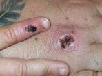 Mpox (monkeypox) is a viral illness caused by the monkeypox virus, a species of the genus Orthopoxvirus. Mpox (monkeypox) is a viral illness caused by the monkeypox virus, a species of the genus Orthopoxvirus.