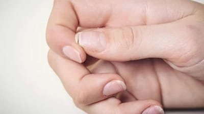 Brittle nails: Weak and brittle nails can also be a sign of calcium deficiency. (Shutterstock) Brittle nails: Weak and brittle nails can also be a sign of calcium deficiency. (Shutterstock)