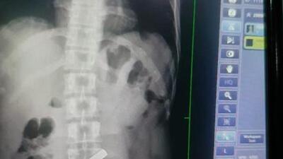 UP smuggler swallows 8 gold bars, JJ docs help purge him