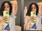 Aishwarya Sharma shares a picture of her bruised arm.