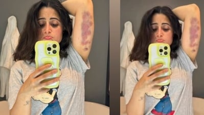 Aishwarya Sharma shares a picture of her bruised arm. Aishwarya Sharma shares a picture of her bruised arm.