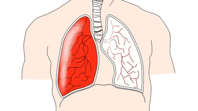 Role of human T cells in controlling respiratory syncytial virus infection: Study (Image by Clker-Free-Vector-Images from Pixabay ) Role of human T cells in controlling respiratory syncytial virus infection: Study (Image by Clker-Free-Vector-Images from Pixabay )