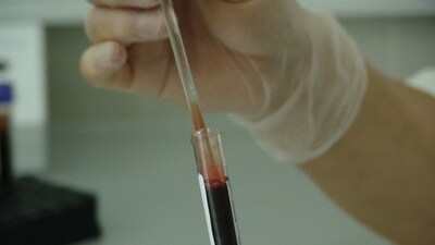 Risk biomarkers can anticipate severe adverse effects of stem cell transplant: Study (Pixabay) Risk biomarkers can anticipate severe adverse effects of stem cell transplant: Study (Pixabay)