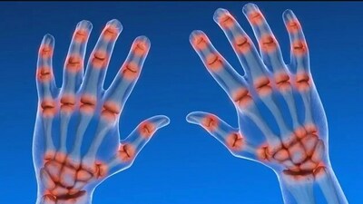 Living with autoimmune arthritis: Tips for managing symptoms and improving quality of life (Photo by Twitter/endocrinology20) Living with autoimmune arthritis: Tips for managing symptoms and improving quality of life (Photo by Twitter/endocrinology20)
