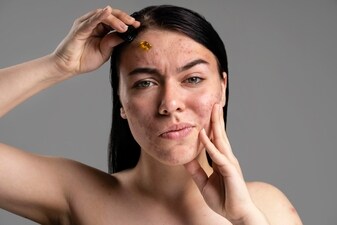 Hyperpigmentation is a common skin concern that affects many individuals, causing uneven skin tone and dark patches. (Freepik)