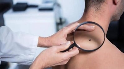 Memory killer cells can improve melanoma patients' chances of survival: Study (Shutterstock)