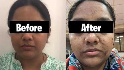 After getting a ₹17k luxe facial leaves permanent burn marks on woman’s face. (Prashant Rane/Twitter) After getting a ₹17k luxe facial leaves permanent burn marks on woman’s face. (Prashant Rane/Twitter)