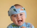 Shedding light on kids receiving helmet treatment for head-flattening: Study Shedding light on kids receiving helmet treatment for head-flattening: Study