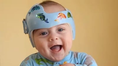 Shedding light on kids receiving helmet treatment for head-flattening: Study (Unsplash) Shedding light on kids receiving helmet treatment for head-flattening: Study (Unsplash)