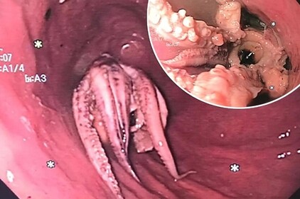 Doctors removed an octopus from a 55-year-old Singapore man following difficulty in swallowing. (NYP)