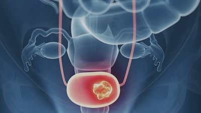Bladder cancer: Symptoms to look for to distinguish between infection and cancer (Photo by Twitter/MedscapeCME) Bladder cancer: Symptoms to look for to distinguish between infection and cancer (Photo by Twitter/MedscapeCME)