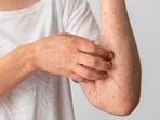 It is crucial for adults to be aware of the unique early signs of dengue, enabling early detection and intervention,