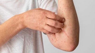 It is crucial for adults to be aware of the unique early signs of dengue, enabling early detection and intervention, (Freepik) It is crucial for adults to be aware of the unique early signs of dengue, enabling early detection and intervention, (Freepik)