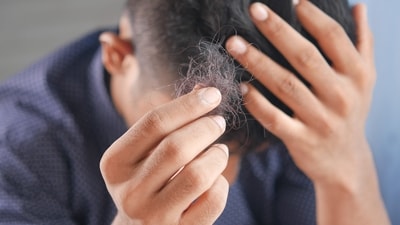 Can sugary beverages cause Alopecia, hair loss or baldness among men? Expert reveals (Unsplash) Can sugary beverages cause Alopecia, hair loss or baldness among men? Expert reveals (Unsplash)