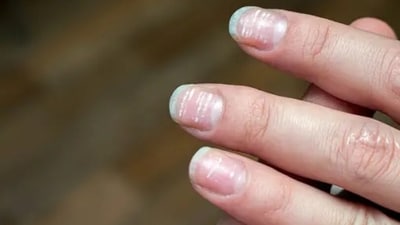 White spots in nails can denote liver or heart disease, or deficiency of iron or zinc in the body. (Unsplash) White spots in nails can denote liver or heart disease, or deficiency of iron or zinc in the body. (Unsplash)