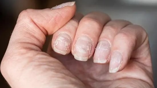 Peeling nails are symptoms of keratin being damaged. Sometimes deficiency in omega 3 fatty acids can also be the reason of peeling nails.&nbsp;(Unsplash)