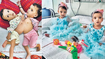The twin girls, Riddhi and Siddhi, were separated on June 8 after a 12.5 hour-long surgery at AIIMS-Delhi. (PTI) The twin girls, Riddhi and Siddhi, were separated on June 8 after a 12.5 hour-long surgery at AIIMS-Delhi. (PTI)