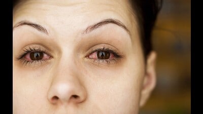 The condition starts in one eye and can spread to the other eye within a few days. (HT Photo) The condition starts in one eye and can spread to the other eye within a few days. (HT Photo)