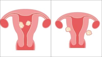 Cause and treatment of uterine fibroids that lead to heavy bleeding during menses (Pixabay) Cause and treatment of uterine fibroids that lead to heavy bleeding during menses (Pixabay)