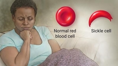 Sickle cell disease in children: Early detection, intervention and long-term management (Photo by Twitter/EllenDomaeko) Sickle cell disease in children: Early detection, intervention and long-term management (Photo by Twitter/EllenDomaeko)