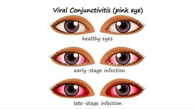 Conjunctivitis: Causes, how this viral eye infection spreads, treatment and prevention tips (Photo by Twitter/EmpoweringMMs) Conjunctivitis: Causes, how this viral eye infection spreads, treatment and prevention tips (Photo by Twitter/EmpoweringMMs)