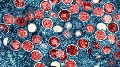 There were no severe cases or deaths from mpox, the virus that was until recently known as monkeypox. (AP/File) There were no severe cases or deaths from mpox, the virus that was until recently known as monkeypox. (AP/File)